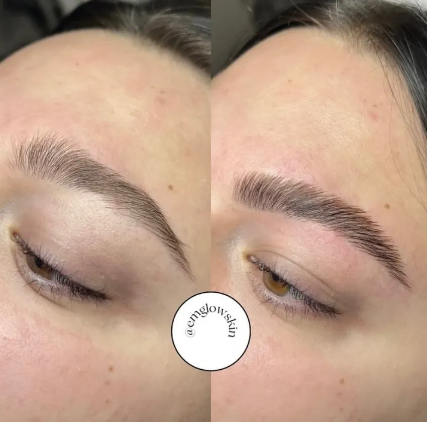 EmGlowSkin before & after result 1