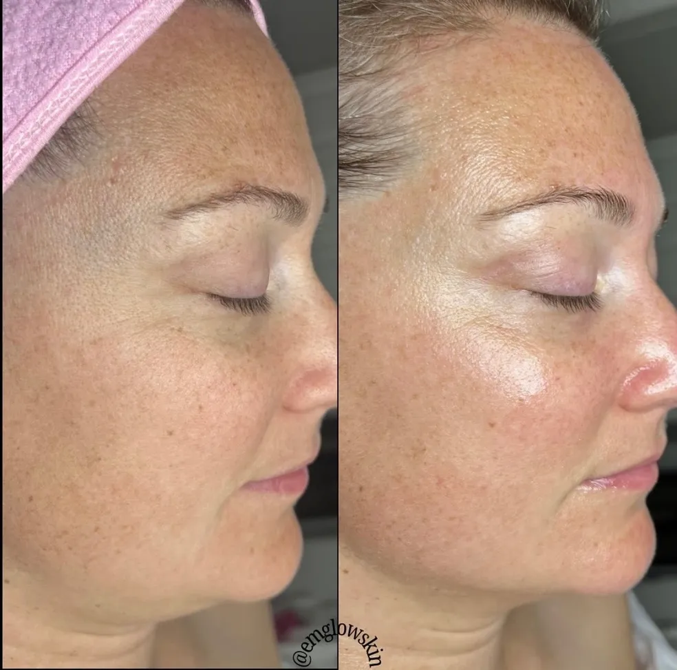 EmGlowSkin before & after result 2