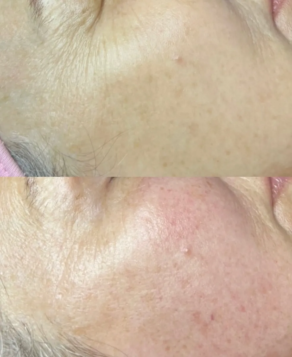 EmGlowSkin before & after result 4