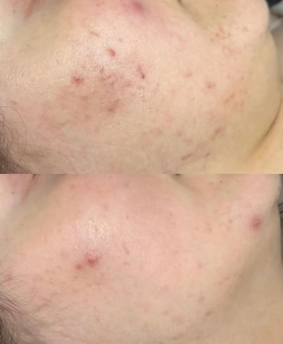 EmGlowSkin before & after result 6