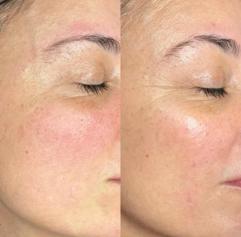 EmGlowSkin before & after result 8