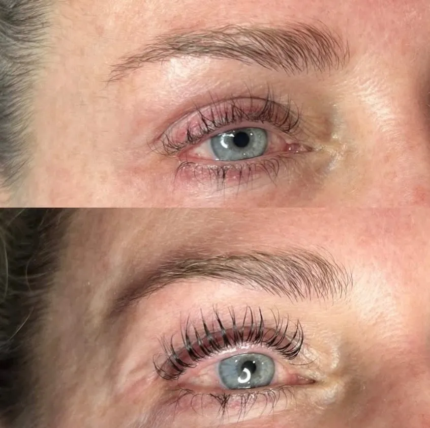 EmGlowSkin before & after result 9